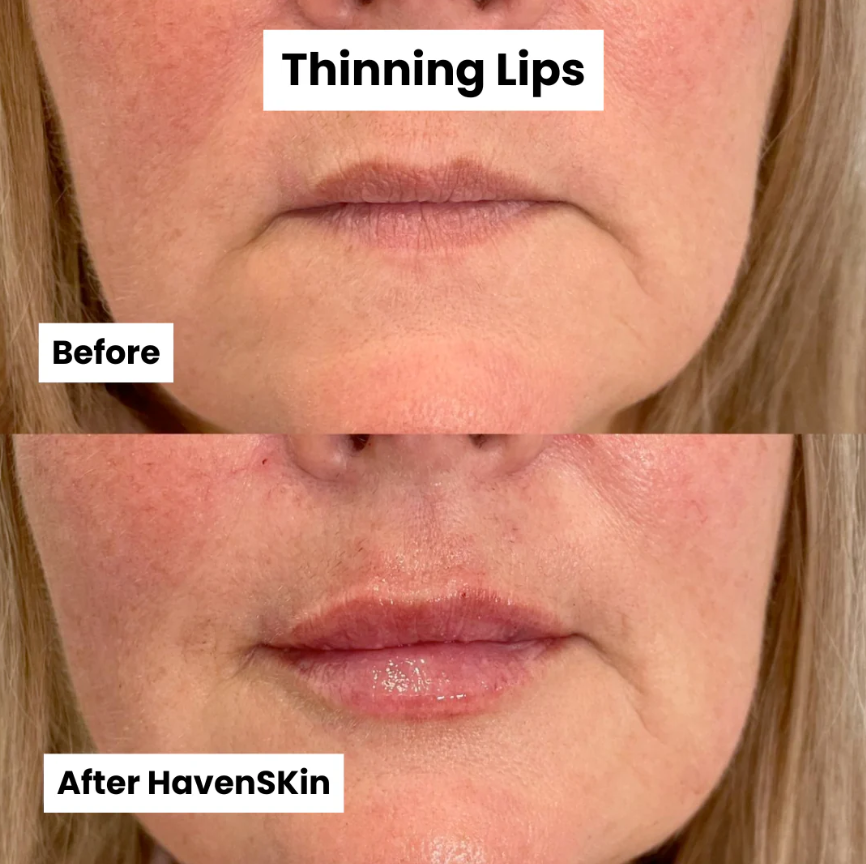 Micro-needle Peptide Serum